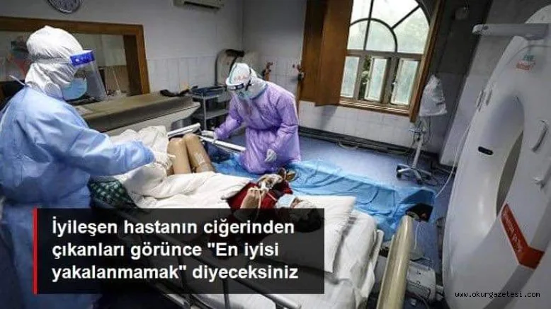 İyileşen korona hastasının akciğerinde sıvı veya parçacık dolu keseler bulundu